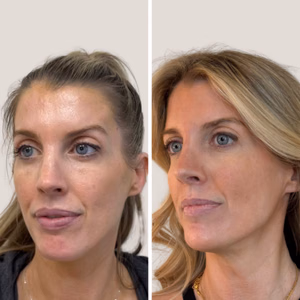 Full face treatment before and after photo, side view