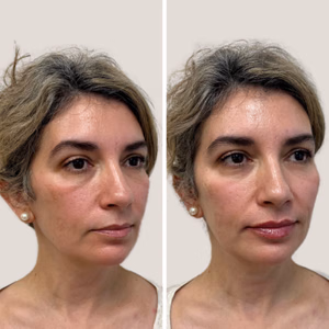 Full face treatment before and after photo, front view