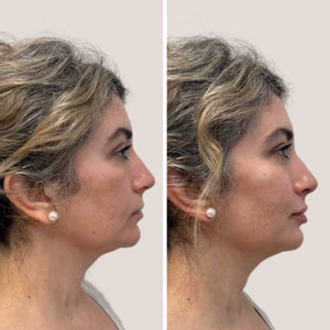 Full face treatment before and after photo, side view