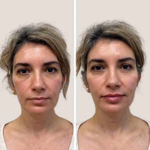 Full face treatment before and after photo, front view