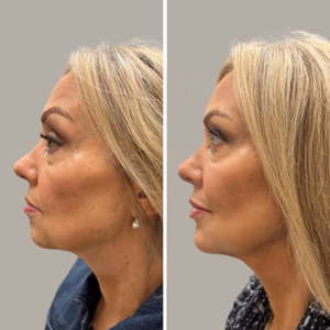 Full face treatment before and after photo, side view