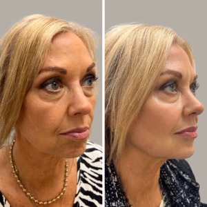 Full face treatment before and after photo, multiple views