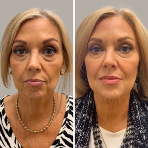 Full face treatment before and after photo, multiple views