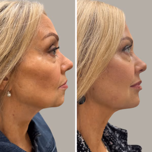 Full face treatment before and after photo, side view