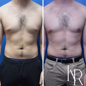 Gynecomastia surgery before and after photo, front view