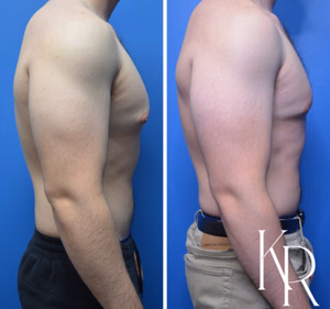 Gynecomastia surgery before and after photo, front view