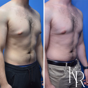 Gynecomastia surgery before and after photo, side view
