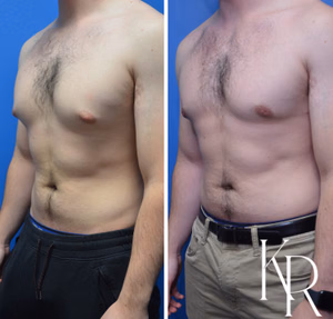 Gynecomastia surgery before and after photo, front view