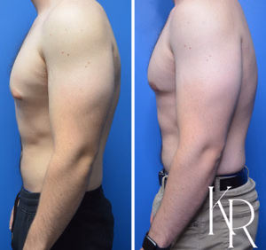 Gynecomastia surgery before and after photo, side view