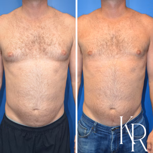 Gynecomastia surgery before and after photo, front view