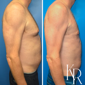 Gynecomastia surgery before and after photo, front view