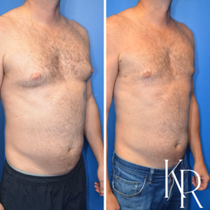 Gynecomastia surgery before and after photo, side view