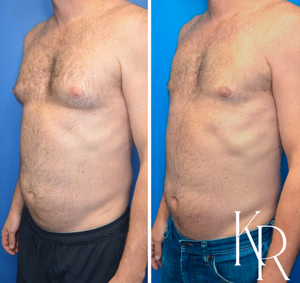 Gynecomastia surgery before and after photo, front view