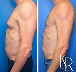 Gynecomastia surgery before and after photo, side view