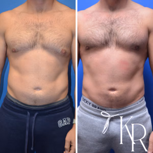 Gynecomastia surgery before and after photo, front view
