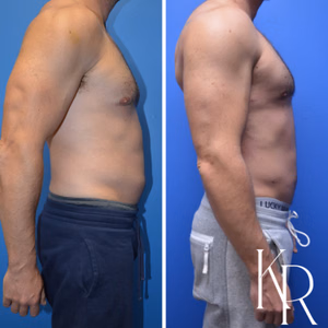 Gynecomastia surgery before and after photo, front view
