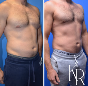Gynecomastia surgery before and after photo, side view
