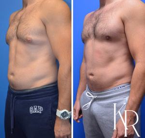 Gynecomastia surgery before and after photo, front view