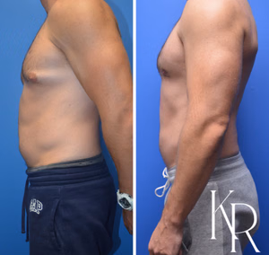 Gynecomastia surgery before and after photo, side view