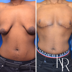 Gynecomastia surgery before and after photo, front view