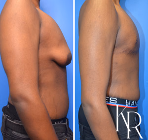 Gynecomastia surgery before and after photo, side view