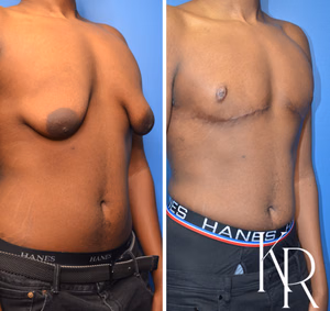 Gynecomastia surgery before and after photo, side view