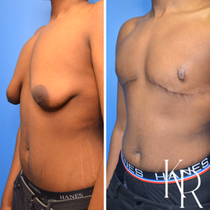 Gynecomastia surgery before and after photo, side view