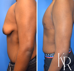 Gynecomastia surgery before and after photo, side view