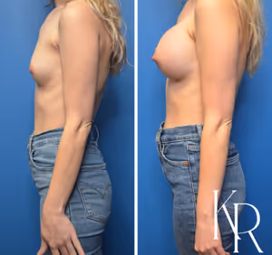 Inverted nipple repair before and after photo, side view