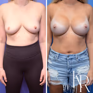 Inverted nipple repair before and after photo, front view