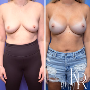 Inverted nipple repair before and after photo, front view