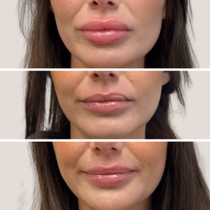 Dermal filler before and after photo, close-up view