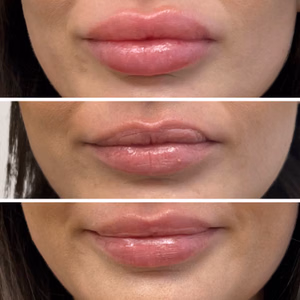 Dermal filler before and after photo, close-up view