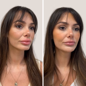 Dermal filler before and after photo, multiple views