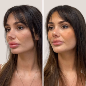 Dermal filler before and after photo, close-up view