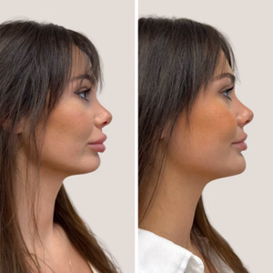 Dermal filler before and after photo, side view