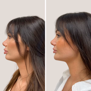 Dermal filler before and after photo, side view
