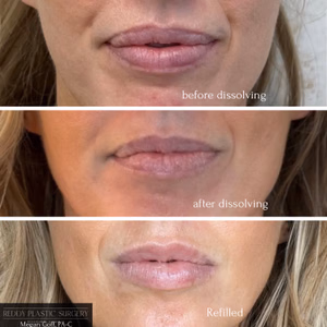 Dermal filler before and after photo, close-up view