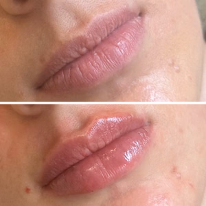 Dermal filler before and after photo, close-up view