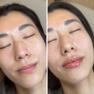 Dermal filler before and after photo, close-up view