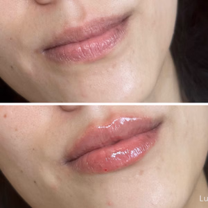 Dermal filler before and after photo, close-up view
