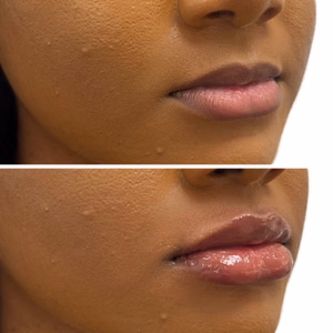 Dermal filler before and after photo, close-up view