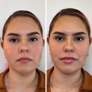 Dermal filler before and after photo, close-up view