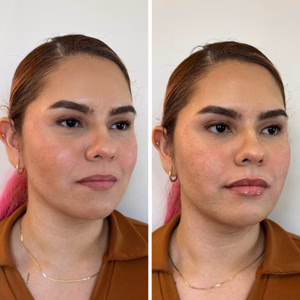 Dermal filler before and after photo, front view