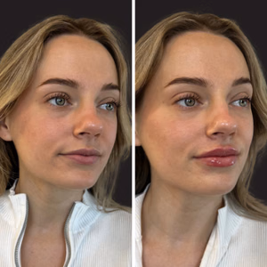 Dermal filler before and after photo, close-up view