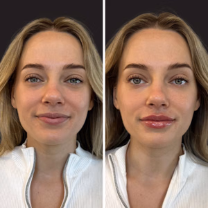 Dermal filler before and after photo, close-up view