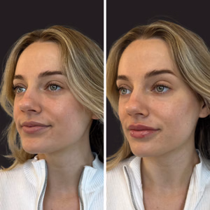 Dermal filler before and after photo, multiple views