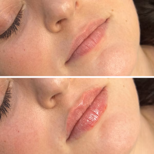 Dermal filler before and after photo, close-up view