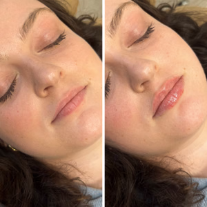 Dermal filler before and after photo, close-up view