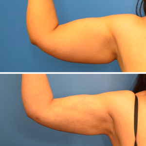 Liposuction before and after photo, side view